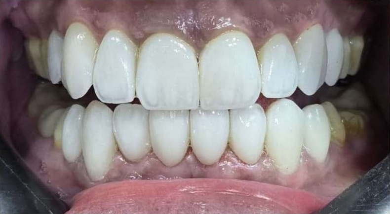 بعد — حشوات تجميلية أمامية